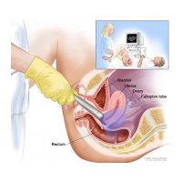 transvaginal.jpg